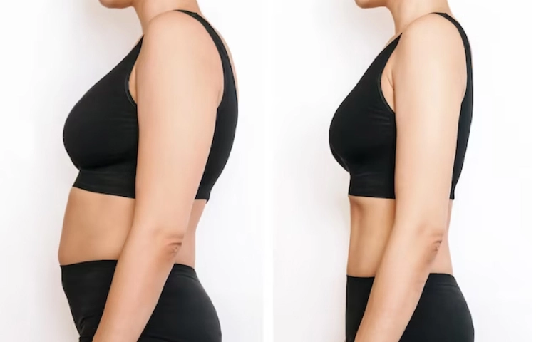 VelaShape Body Slimming Machine Before and After