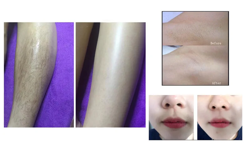 Diode Laser Hair Removal Before and After