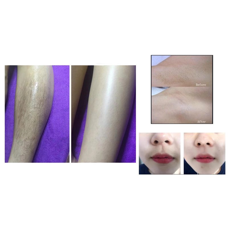applications of portable diode laser hair removal machine