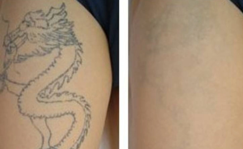 Tattoo Removal Machine Before and After