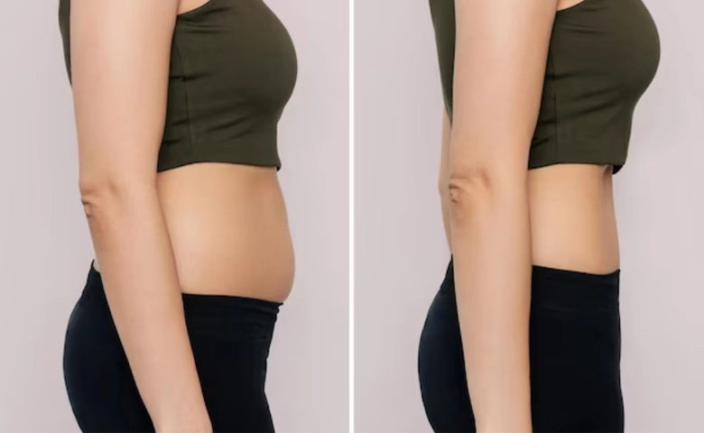 Cryolipolysis Slimming Machine Before and After