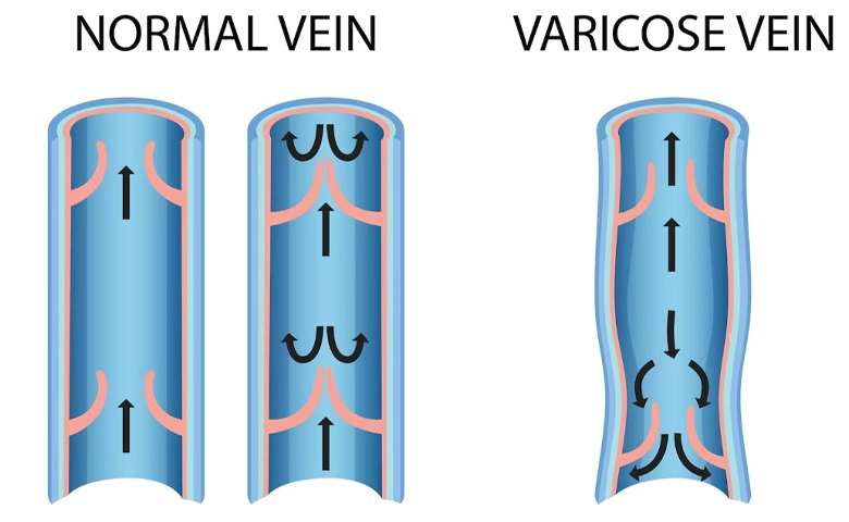 How Does Spider Vein Removal Machine Work？